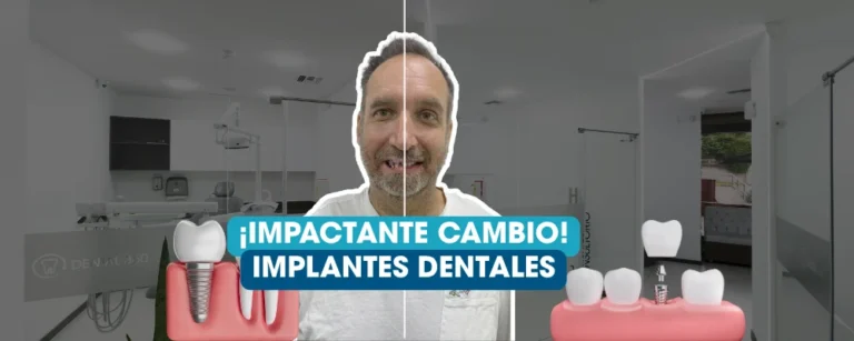Paciente mostrando antes y después de una transformación con implantes dentales en Dental360 Quito