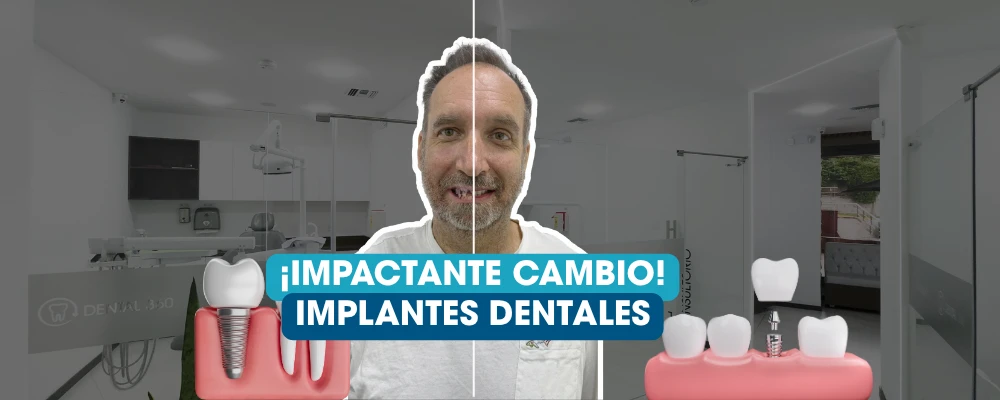 Paciente mostrando antes y después de una transformación con implantes dentales en Dental360 Quito